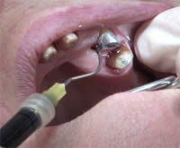 Rétraction gingivale
