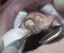 Rétraction gingivale